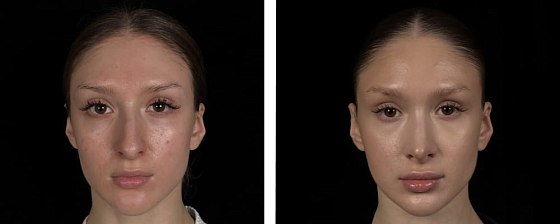 Ринопластика: до и после – фото 1